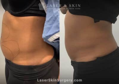 CoolSculpting treatments to reduce unwanted fat on the stomach