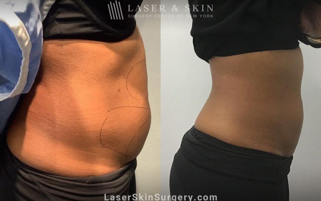 coolsculpting body contouring results