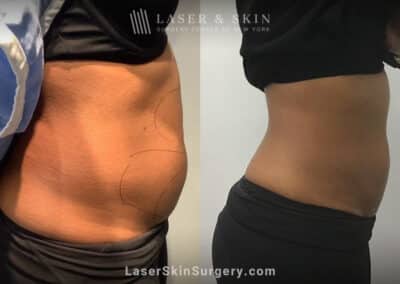 CoolSculpting treatments to reduce unwanted fat on the stomach