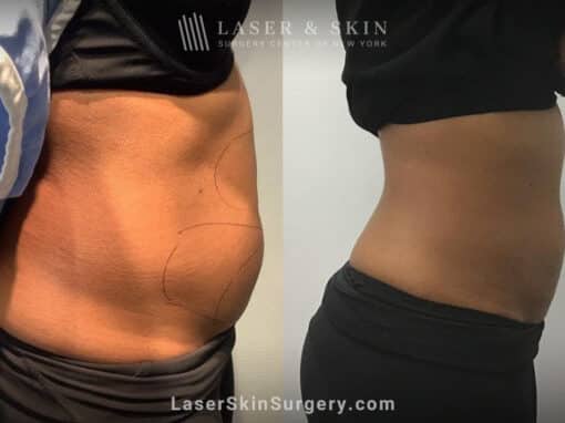 CoolSculpting treatments to reduce unwanted fat on the stomach