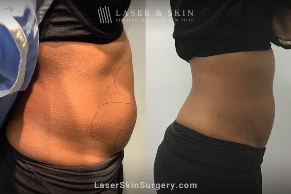 Best Body Contouring Procedures After Weight Loss Laser NY