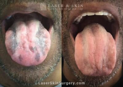 Ruby Laser Treatments for dark spots on the tongue