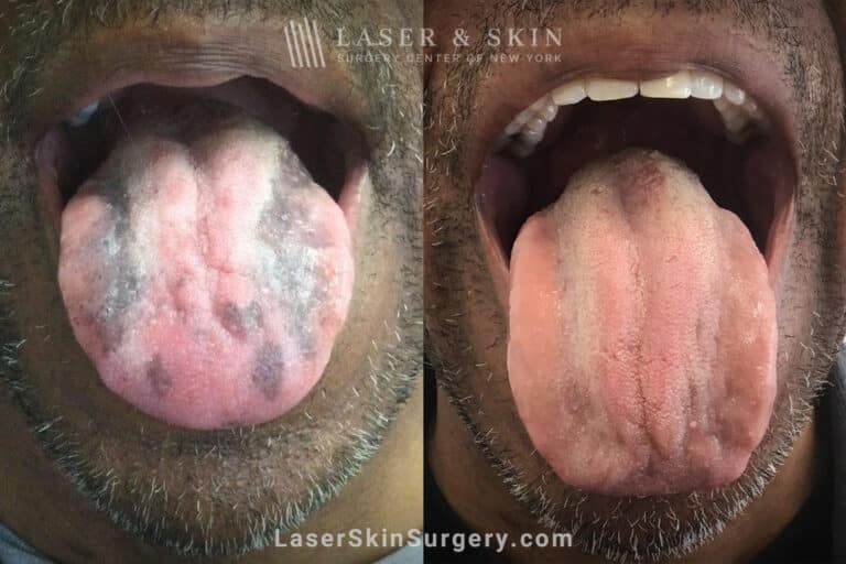 Ruby Laser Treatments for dark spots on the tongue