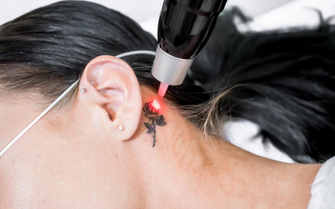5 Things to Consider When Choosing a Tattoo Removal Dermatologist