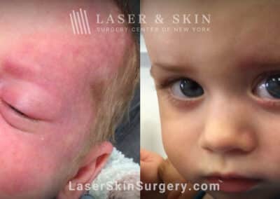 Vbeam treatment to remove port wine birthmark from infant’s face