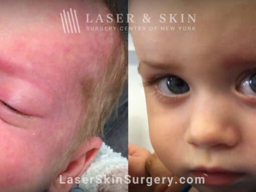 Vbeam treatment to remove port wine birthmark from infant’s face