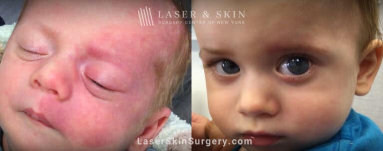 Vbeam treatment to remove port wine birthmark from infant’s face