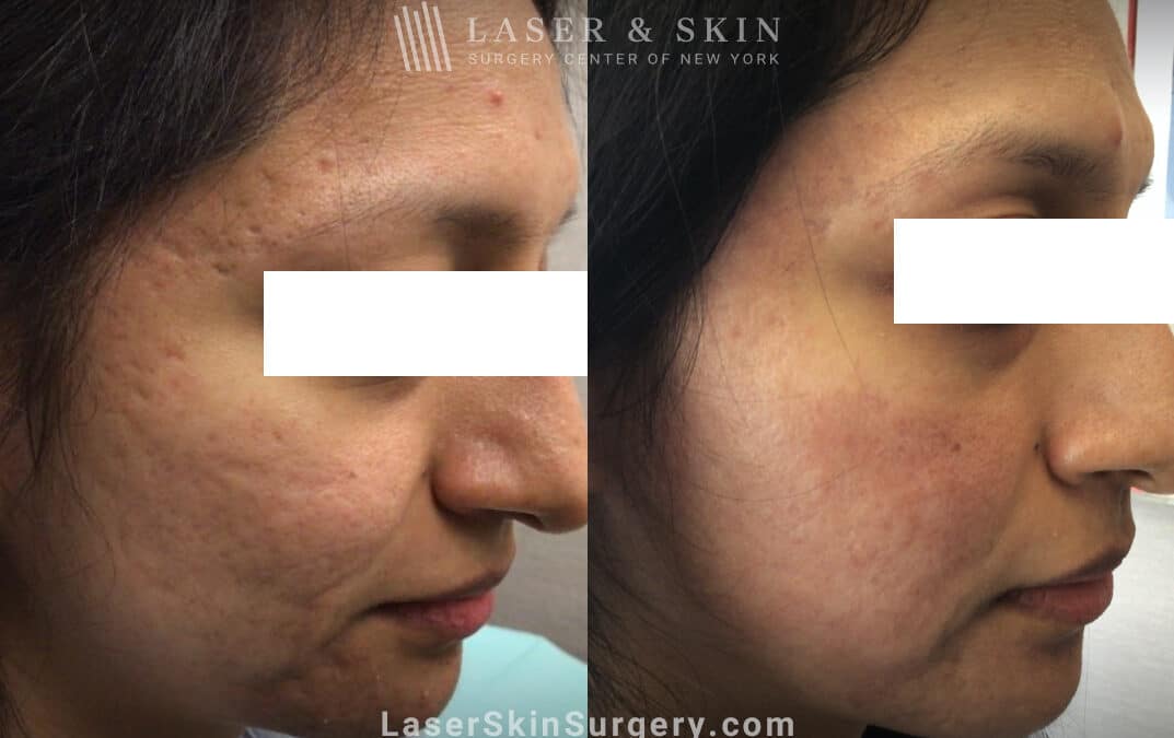 boxcar acne scar treatment before and after