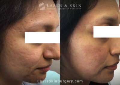 Fractional CO2 laser treatment for acne scars