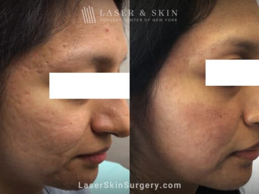 Fractional CO2 laser treatment for acne scars