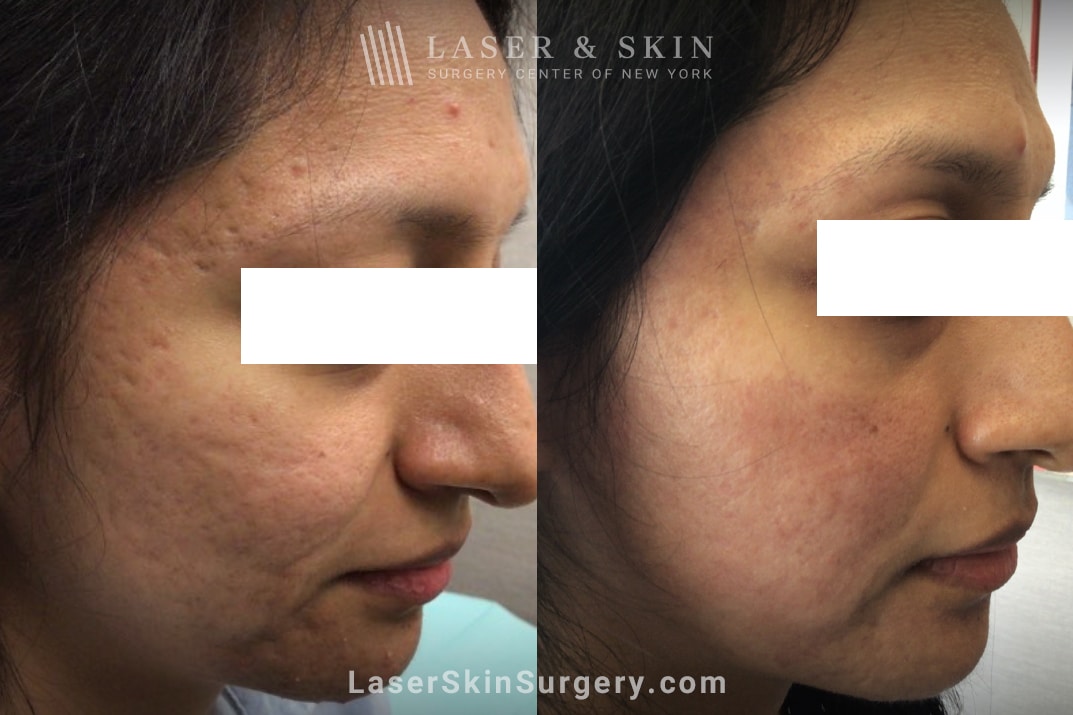 boxcar acne scar treatment before and after