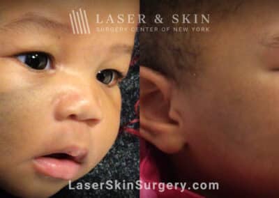 PicoPlus treatments to remove nevus of ota from infant’s face