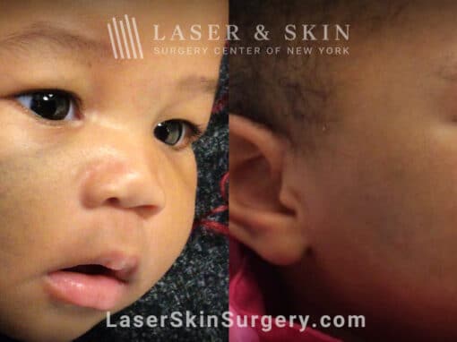 PicoPlus treatments to remove nevus of ota from infant’s face