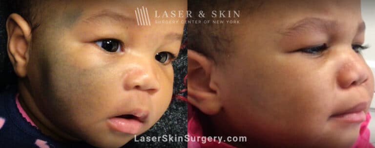 PicoPlus treatments to remove nevus of ota from infant’s face