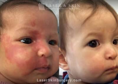 10 laser treatments to a port wine birthmark birth infant’s face
