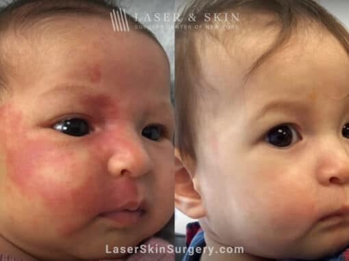 10 laser treatments to a port wine birthmark birth infant’s face