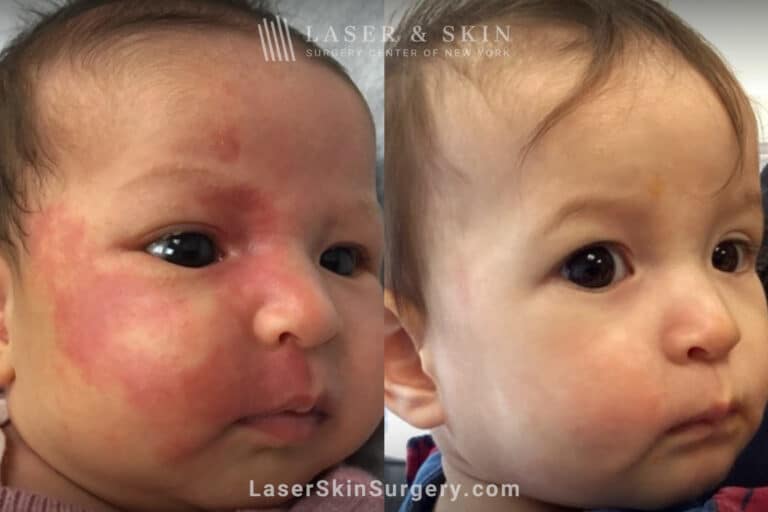 10 laser treatments to a port wine birthmark birth infant’s face