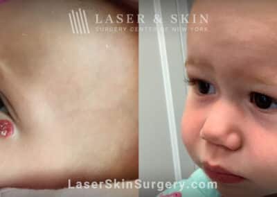 Pulsed dye laser to treat a hemangioma under infant’s eye