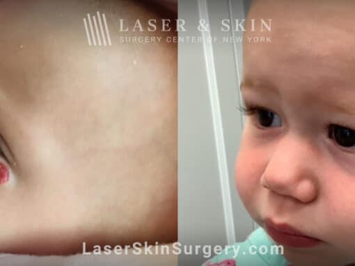 Pulsed dye laser to treat a hemangioma under infant’s eye