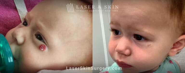 Pulsed dye laser to treat a hemangioma under infant’s eye