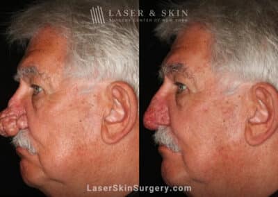 Radiofrequency ablation and erbium laser to reduce the symptoms of rhinophyma