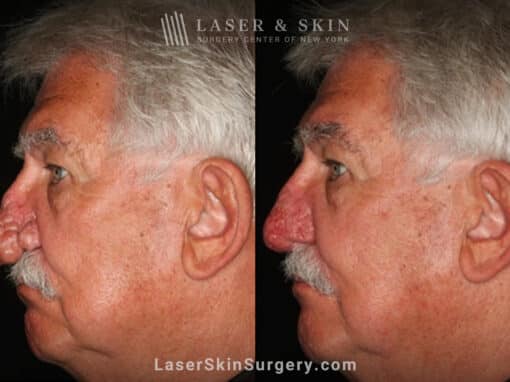 Radiofrequency ablation and erbium laser to reduce the symptoms of rhinophyma