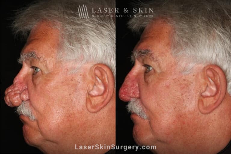 Radiofrequency ablation and erbium laser to reduce the symptoms of rhinophyma