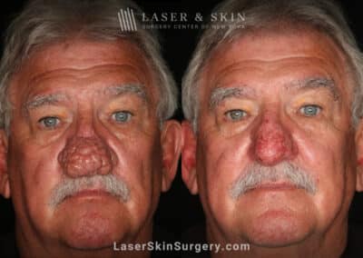 Radiofrequency ablation and erbium laser to reduce the symptoms of rhinophyma