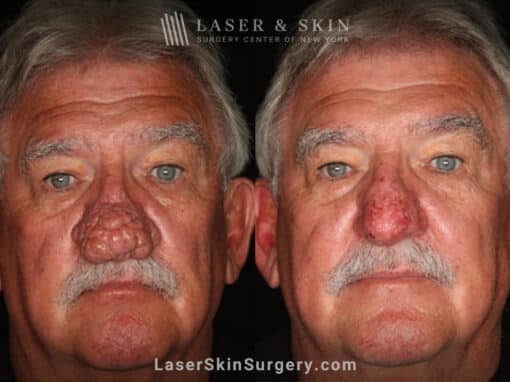 Radiofrequency ablation and erbium laser to reduce the symptoms of rhinophyma