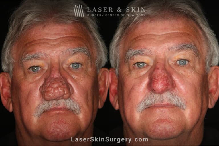 Radiofrequency ablation and erbium laser to reduce the symptoms of rhinophyma