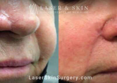 Erbium laser treatments to remove skin flap scar on patient’s nose