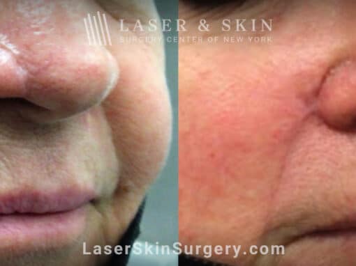 Erbium laser treatments to remove skin flap scar on patient’s nose