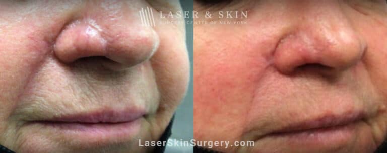 Erbium laser treatments to remove skin flap scar on patient’s nose