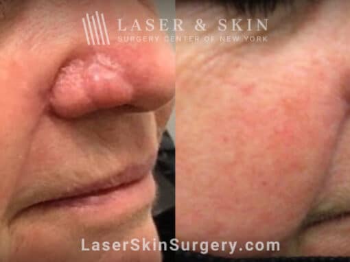 Erbium laser treatments to remove skin flap scar on patient’s nose