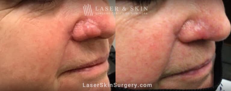 Erbium laser treatments to remove skin flap scar on patient’s nose