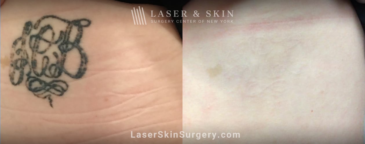 laser tattoo removal before and after in new york