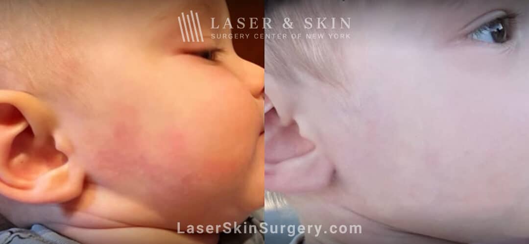Vbeam port wine birthmark removal