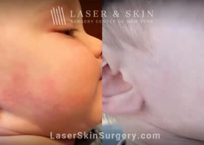 Vbeam port wine birthmark removal