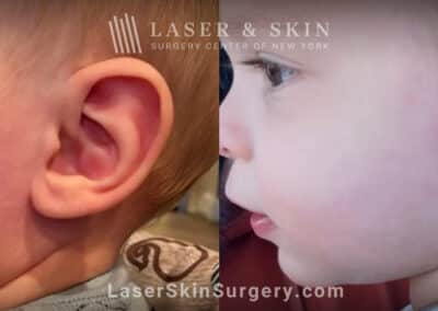 Port wine birthmark removal from infant’s face