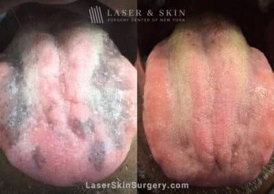 5 Ruby laser treatments to remove tongue pigmentation