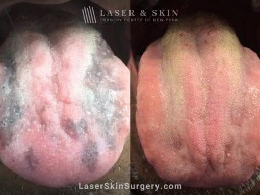 5 Ruby laser treatments to remove tongue pigmentation