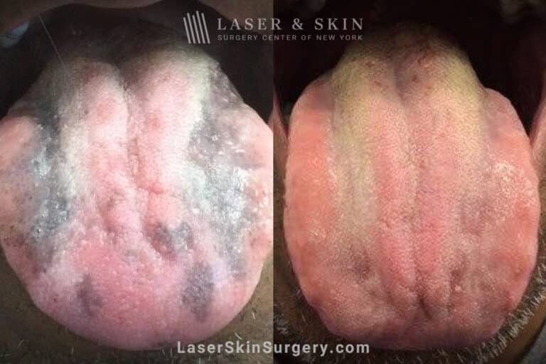 5 Ruby laser treatments to remove tongue pigmentation