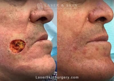 Mohs surgery to remove skin cancer from patient’s cheek
