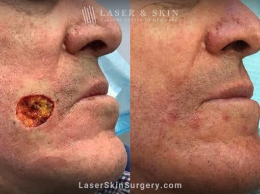 Mohs surgery to remove skin cancer from patient’s cheek