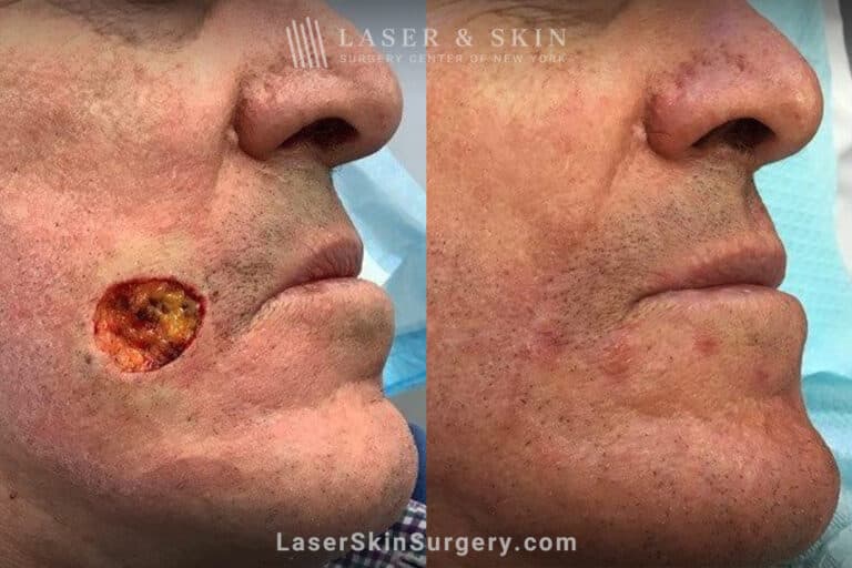 Mohs surgery to remove skin cancer from patient’s cheek