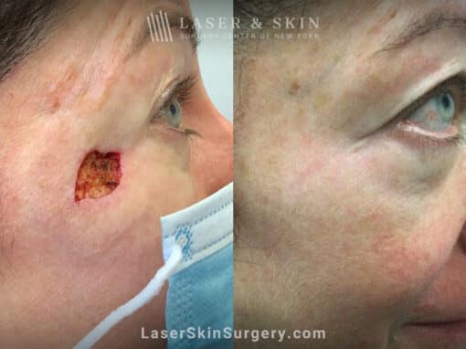 Mohs surgery to remove skin cancer from a patient’s face