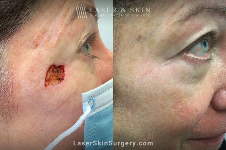 Mohs surgery to remove skin cancer from a patient’s face