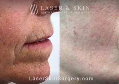 Genius microneedling to smooth perioral lines around the mouth