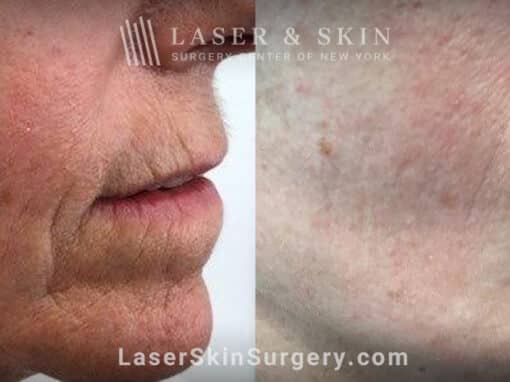 Genius microneedling to smooth perioral lines around the mouth