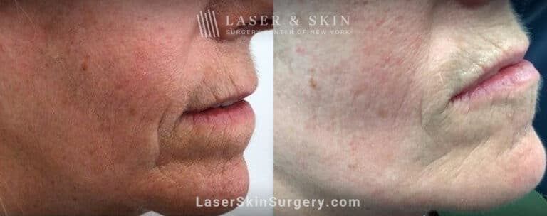 Genius microneedling to smooth perioral lines around the mouth